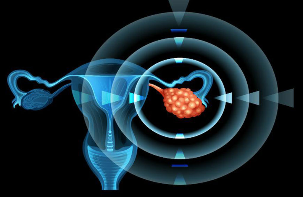Nhiều phụ nữ không biết cơn đau dạ dày thông thường chính là ung thư buồng trứng chết người1