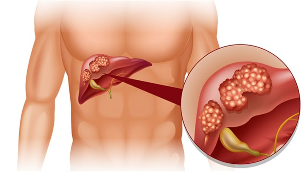 Những dấu hiệu báo động ung thư phổi đã di căn1