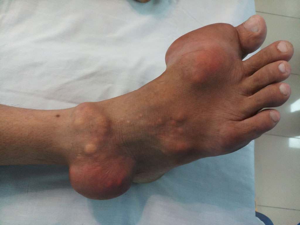 Người bệnh gout khổ sở với tiệc tùng cuối năm1