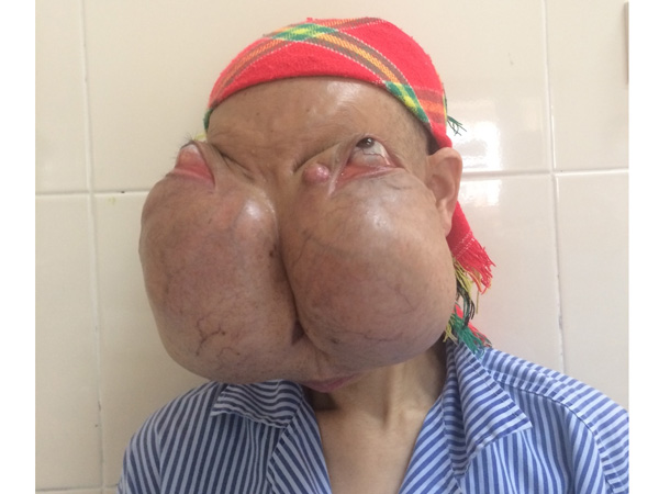 Khuôn mặt bệnh nhân Xiên biến dạng do khối u quái 