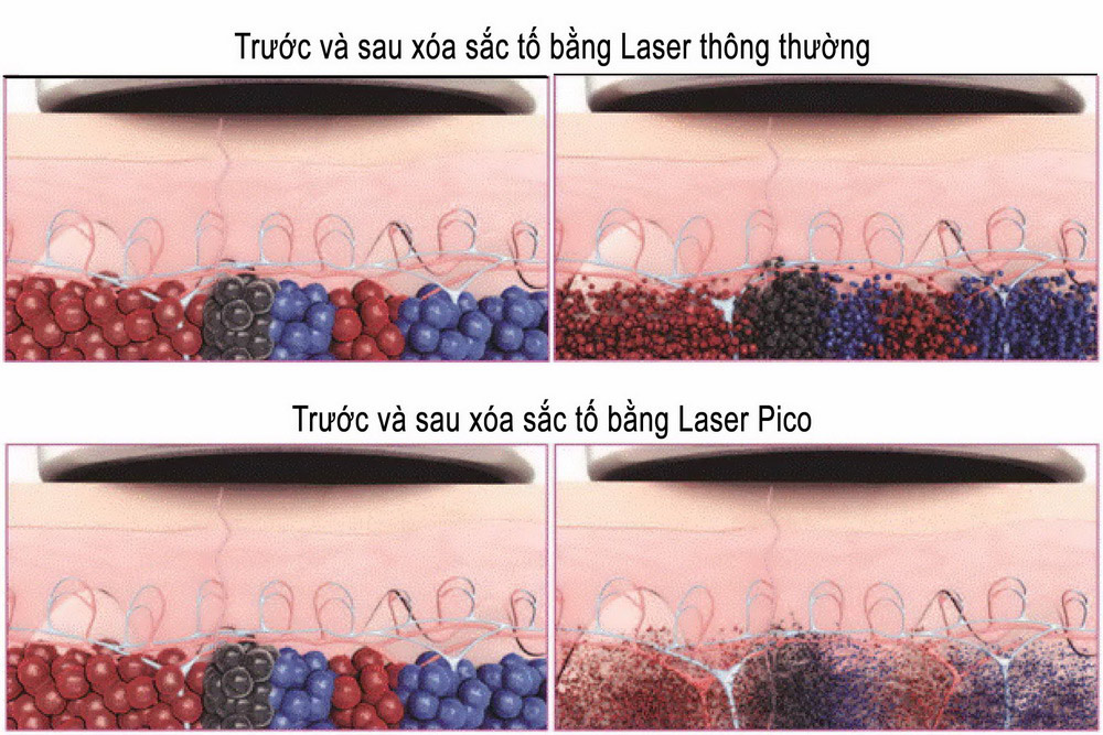 So sánh mức độ phân hủy sắc tố bằng Laser thông thường và Laser Pico
