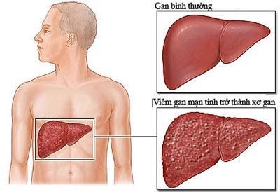 Tương tự như viêm gan B, viêm gan C có thể là một căn bệnh thầm lặng không có triệu chứng cho đến khi thiệt hại nghiêm trọng về gan