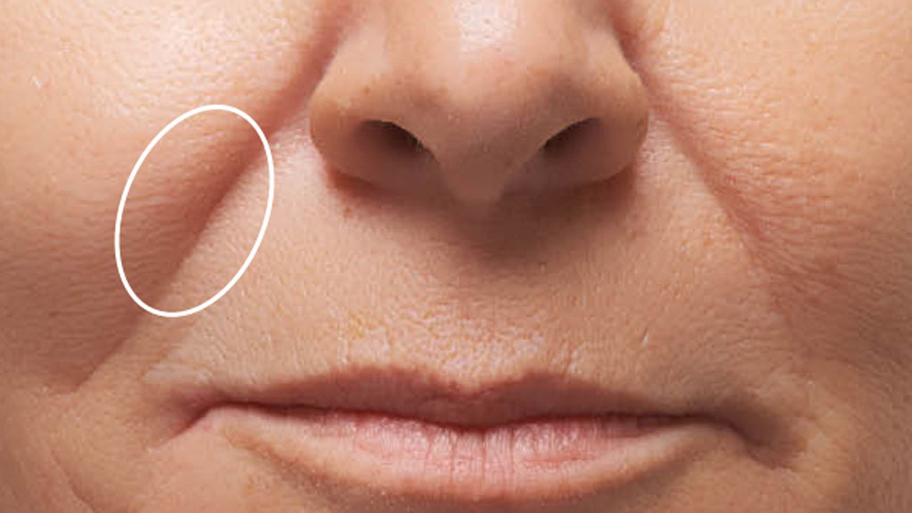 Chấm một ít kem che khuyết điểm lên khoảng giữa nếp gấp mũi má