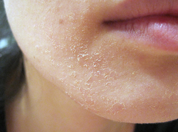 Sữa rửa mặt cho da khô cần có tác dụng xoa dịu da, tăng cường độ ẩm