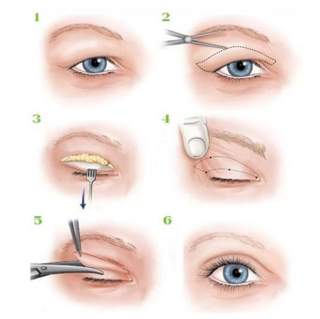 Phương pháp cắt mí cho bạn đôi mắt 2 mí to tròn sáng long lanh, đẹp tự nhiên và hiệu quả vĩnh viễn.