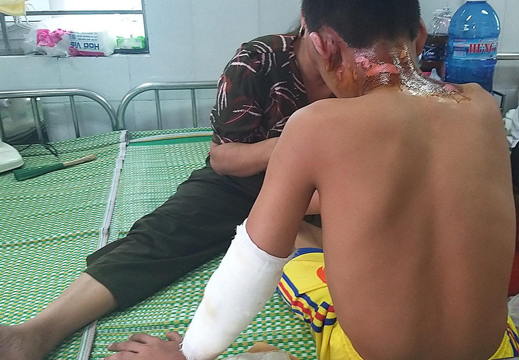 Cầu thủ Nguyễn Duy Đ. bị bỏng nặng ở mặt và 2 tay 