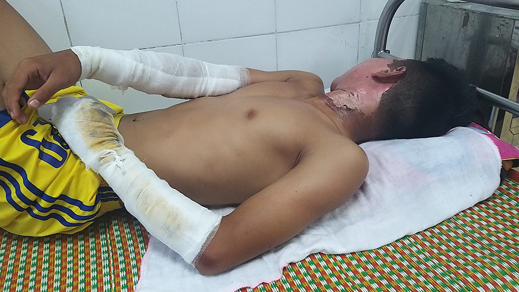 Cầu thủ Tăng Ngọc Q. bị bỏng nặng ở vùng mặt, cổ và tay trái 