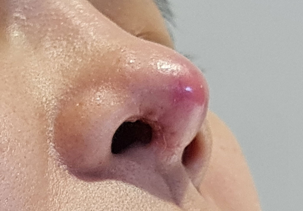 Nạn nhân bị hư mũi khi phẫu thuật tại một cơ sở thẩm mỹ “chui” ở TP.HCM ẢNH: DUY TÍNH