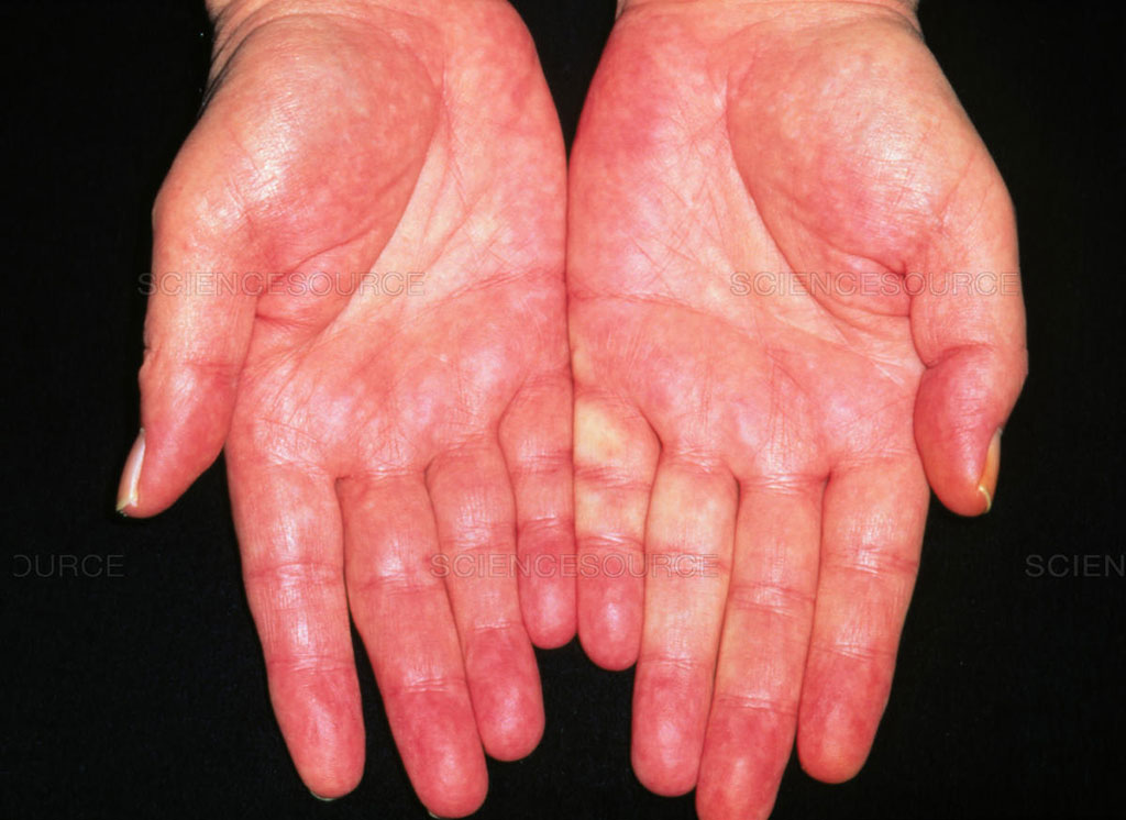 Lòng bàn tay đỏ có thể là dấu hiệu của bệnh viêm gan nhiễm mỡ đã chuyển nặng Shutterstock