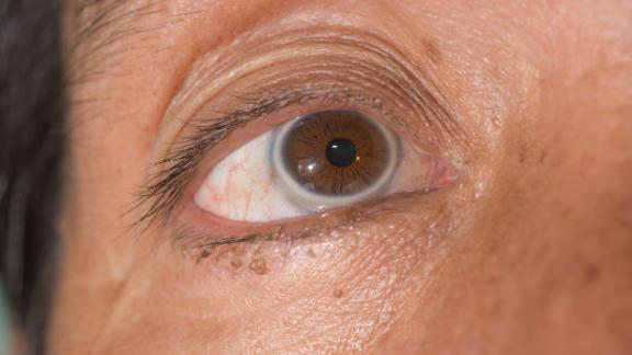 Nếu một người nhìn thấy những u mỡ nhỏ xung quanh mắt, đó có thể là một cảnh báo sớm của cơn đau tim Shutterstock