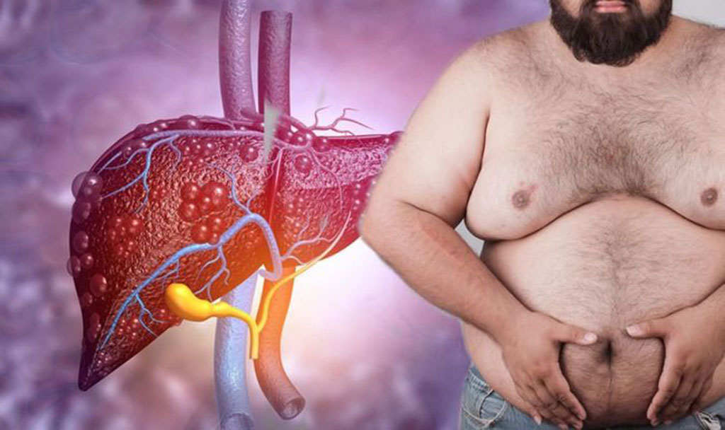 Một trong những dấu hiệu cảnh báo gây sốc nhất của bệnh gan nhiễm mỡ là ngực to lên ở đàn ông SHUTTERSTOCK