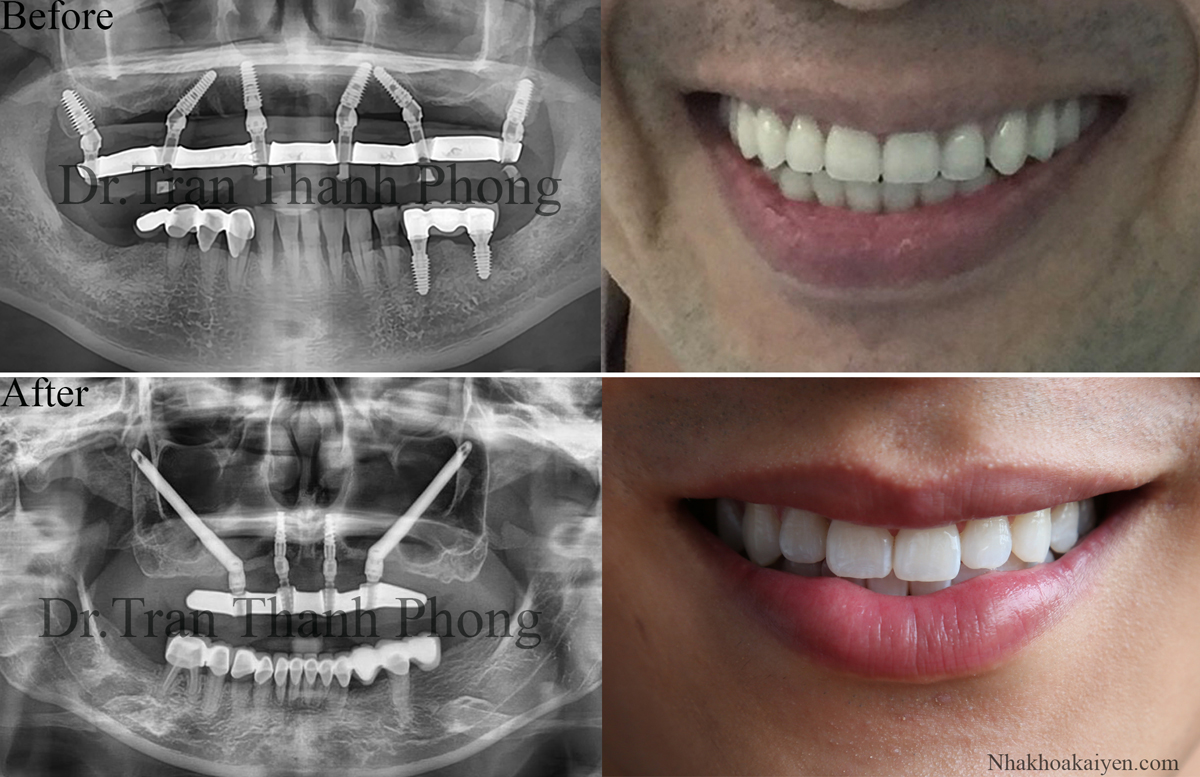 Một số trường hợp đặc biệt phục hồi mất răng toàn hàm lâu năm bằng giải pháp All-on-4