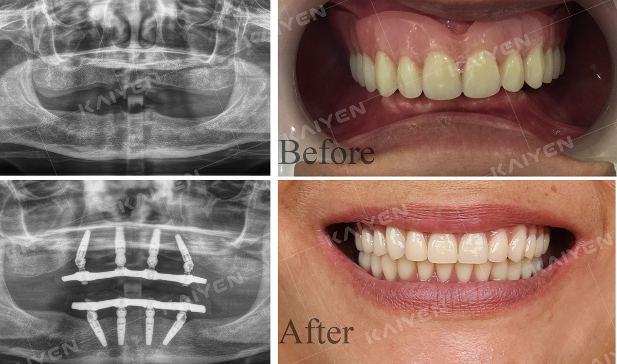 Một ca trồng răng Implant All-on-4 hàm trên và hàm dưới cho bệnh nhân C.M.K - Việt kiều Úc