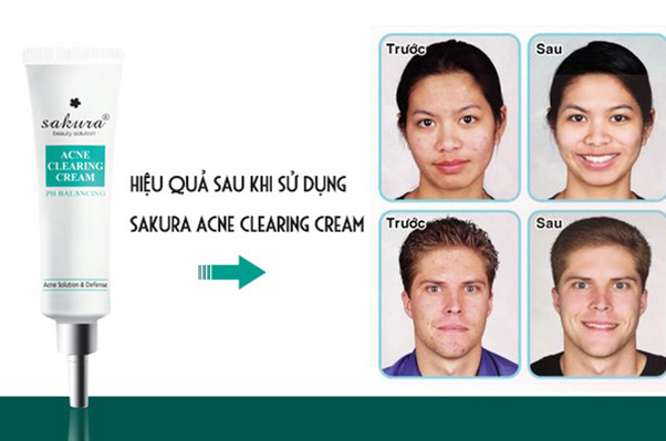 Sakura Acne Clearing Cream là sản phẩm trị mụn hiệu quả, được sử dụng nhiều nhất hiện nay