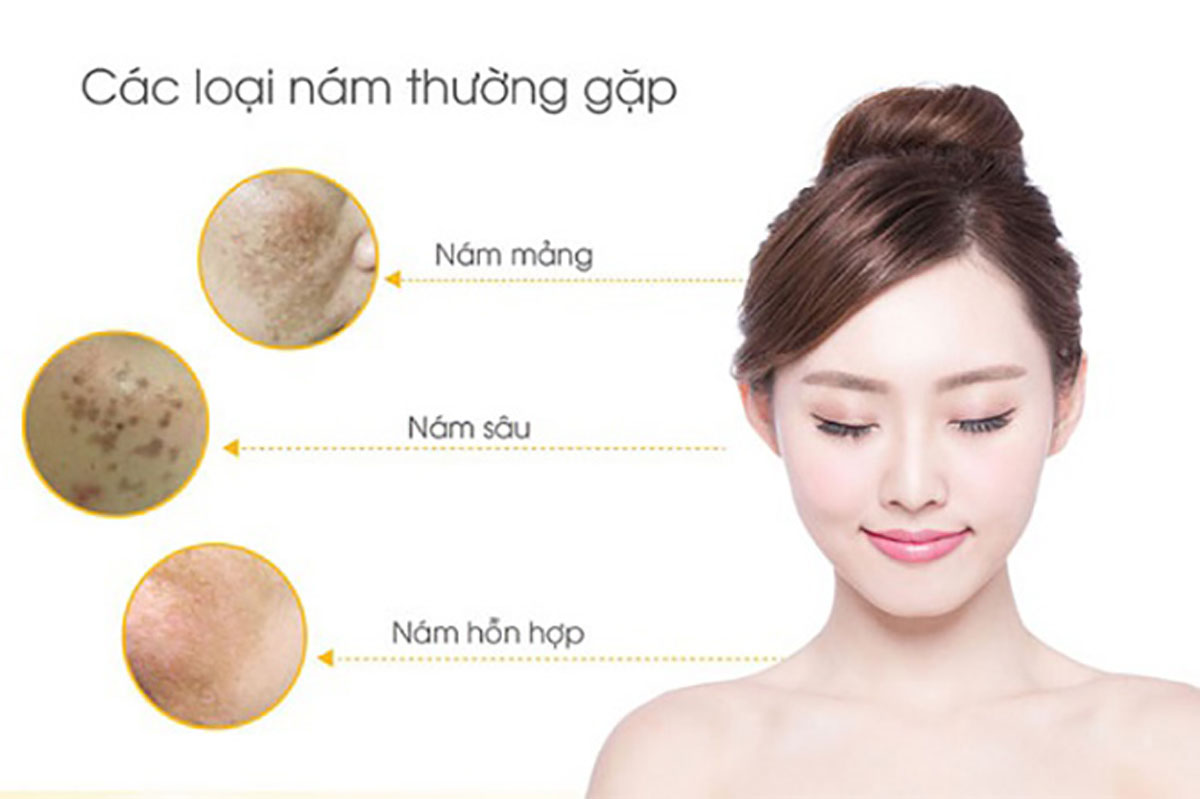 Hiểu rõ từng loại nám, bạn sẽ “vạch ra” giải pháp trị nám hiệu quả