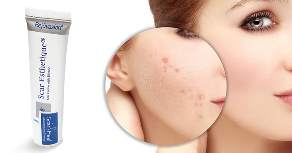 Kem trị sẹo Scar Esthetique làm mờ sẹo thâm đỏ sau mụn hiệu quả