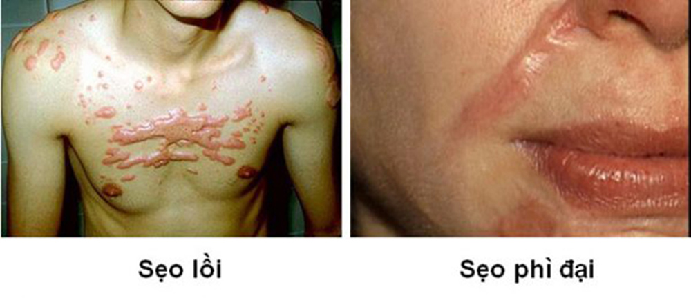 Sẹo lồi có nguy cơ lây lan ra những vùng khác trên da bởi vẫn còn ổ viêm bên trong