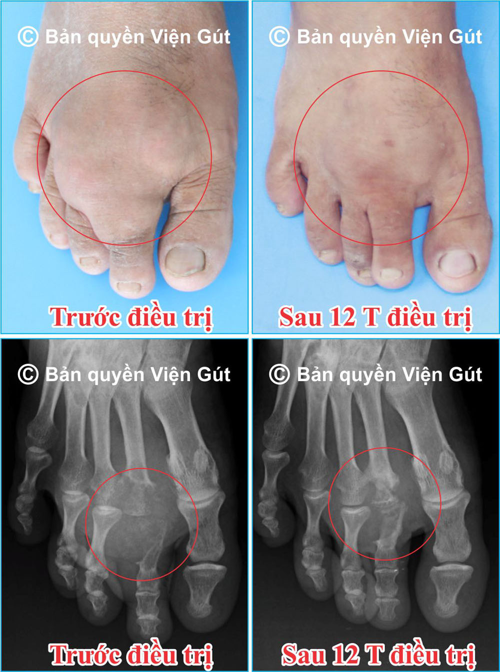 Hình ảnh điều trị phục hồi xương khớp bị phá hủy của Viện Gút được công bố tại EULAR 2019