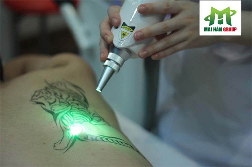 Công nghệ Laser Yag phù hợp sử dụng cho nhiều đối tượng