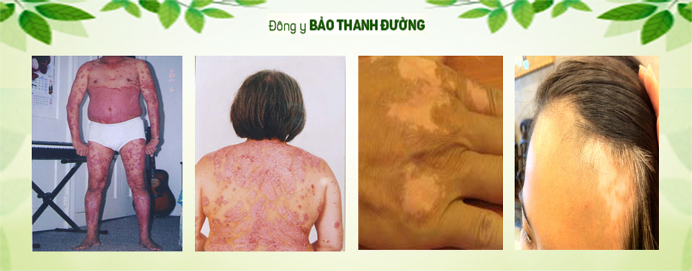 Bảo Thanh Đường có thuốc chữa bí truyền độc đáo trị tận gốc bệnh vảy nến