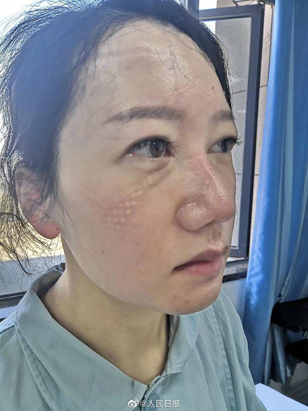 Nữ y tá Lưu Li với khuôn mặt hằn vết khẩu trang sau nhiều ngày làm việc trong khu vực cách ly