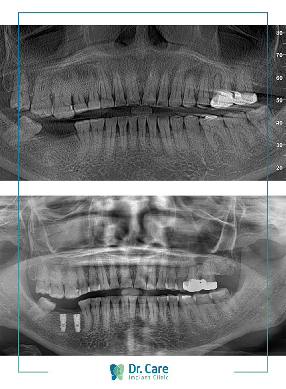 Hình ảnh trước và sau khi trồng răng Implant của cô Lan