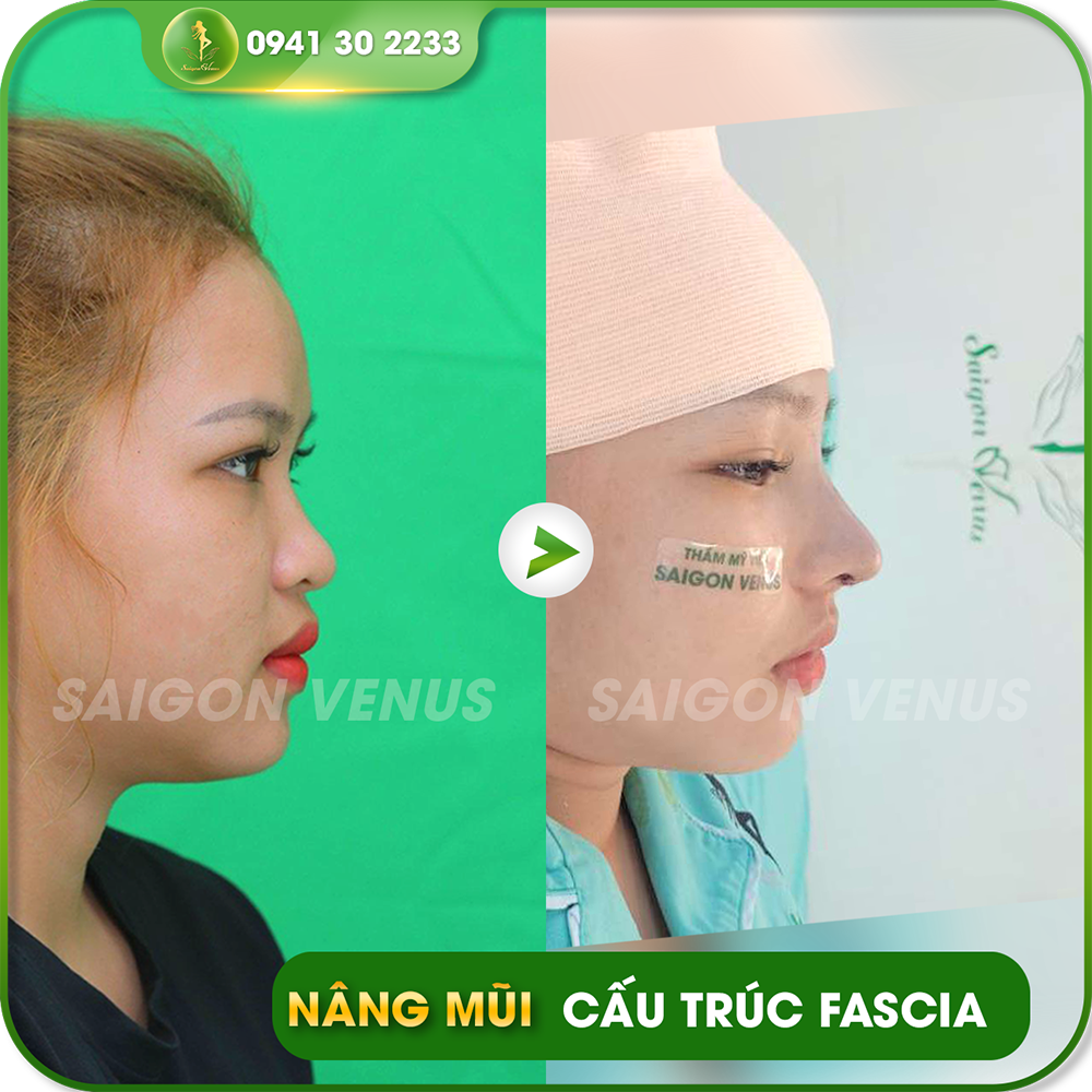 Khách hàng thực tế sau khi nâng mũi Cấu trúc Fascia tại Thẩm mỹ viện Saigon Venus