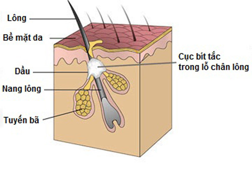 Lỗ chân lông bị bịt kín gây ra mụn