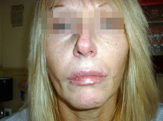 Khuôn mặt biến dạng vì tiêm Botox