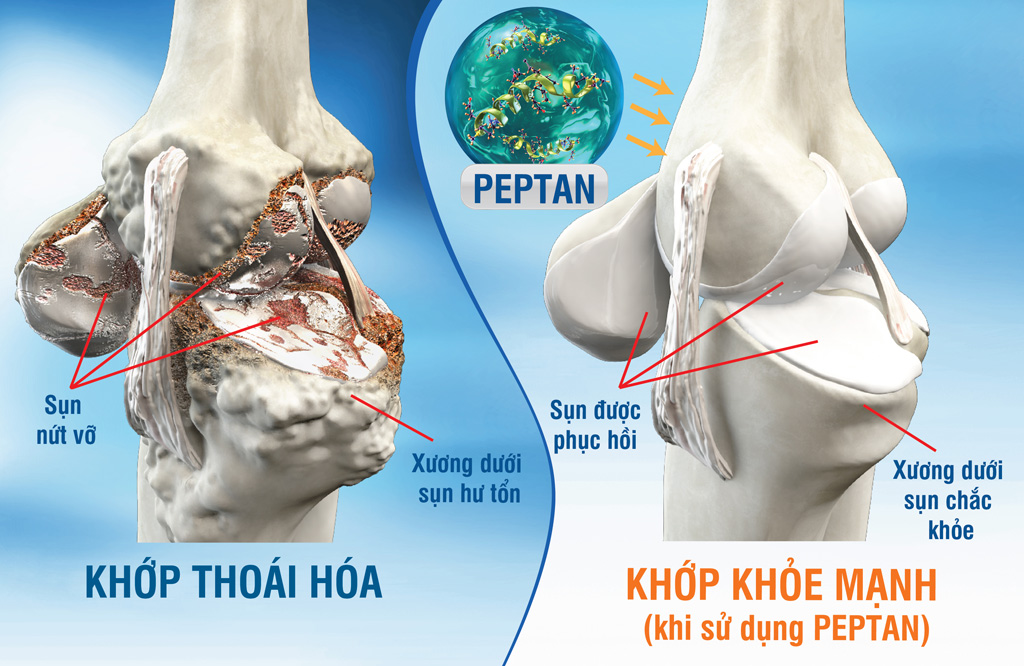 Sử dụng dưỡng chất Peptan (có trong JEX Max) từ sớm để bảo vệ sụn và xương dưới sụn, ngăn ngừa thoái hóa khớp