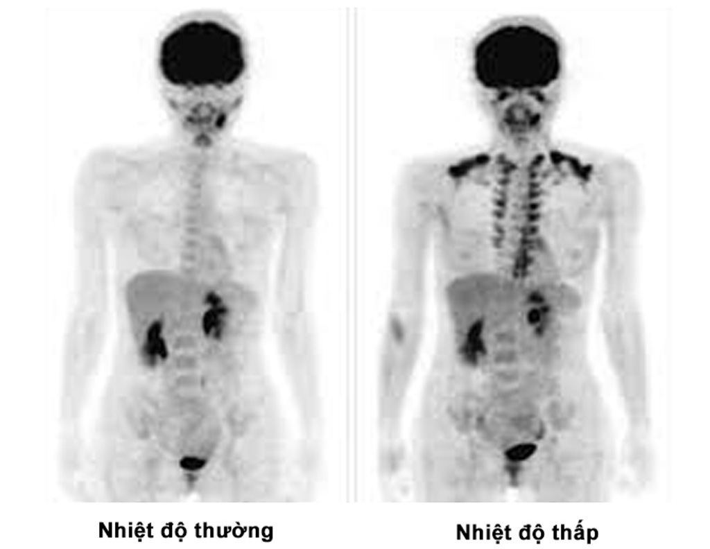 Mỡ nâu (dọc xương sống và bên cạnh xương đòn) được kích hoạt ở nhiệt độ thấp