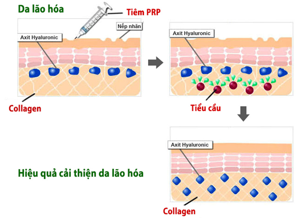 PRP với thành phần tiểu cầu giúp củng cố, tăng cường mạng lưới collagen và elastin