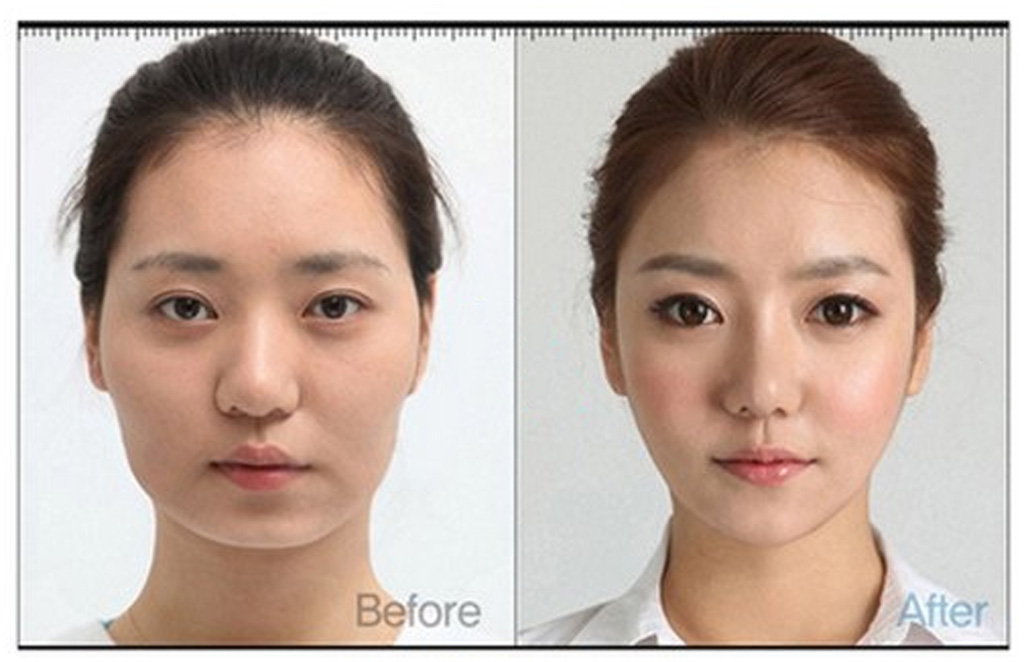 Trước và sau khi tiêm Botox làm thon gọn góc hàm