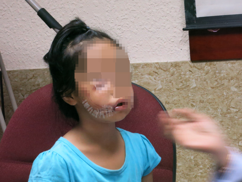 Bé gái bị chó cắn phải khâu hơn 7 mét chỉ - Ảnh: Bệnh viện cung cấp