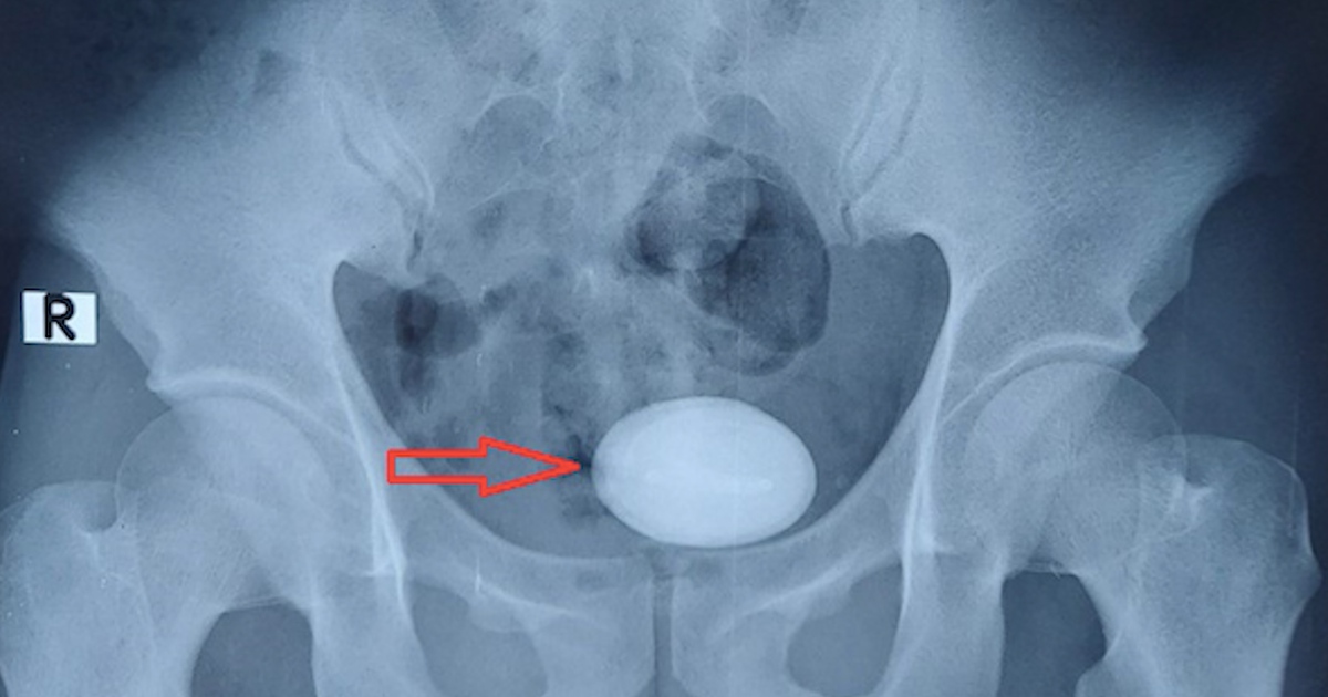 Hy hữu: Quên ống thông 5 năm trong niệu quản, sỏi bàng quang to như trứng ngỗng