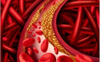 Ngày mới với tin tức sức khỏe: 4 dấu hiệu cholesterol đang 'vượt tầm kiểm soát'