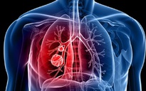 Phát hiện ung thư phổi chỉ trong 6 phút nhờ kiểm tra hơi thở