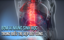 Cần lưu ý gì khi bơm xi măng sinh học trong điều trị xẹp đốt sống?