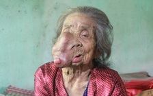 Cụ bà bị khối u khổng lồ 'ăn' cả khuôn mặt: Buồn tủi giữa đời