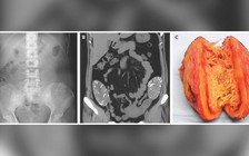Gạc y tế nằm trong bụng ít nhất 6 năm