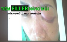 Tiêm filler nâng mũi, một phụ nữ có nguy cơ mù lòa