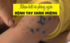 Cách nhận biết và phòng ngừa bệnh tay chân miệng hiệu quả