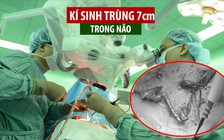 Phẫu thuật lấy kí sinh trùng dài 7cm trong não bệnh nhân