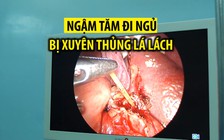 Nhậu say rồi ngậm tăm đi ngủ, một người đàn ông bị xuyên thủng lá lách