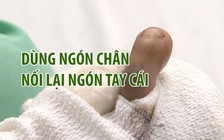 Cắt ngón chân để nối ngón tay cái bị đứt cho người đàn ông