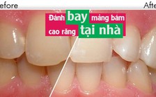 [Khỏe đẹp mỗi ngày] Đánh bay mảng bám cao răng tại nhà