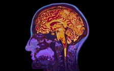 Lú lẫn, 'sương mù não' hậu Covid-19: có biến đổi ở não giống bệnh Alzheimer?