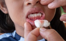 12 cách giúp trị chảy máu nướu răng tại nhà