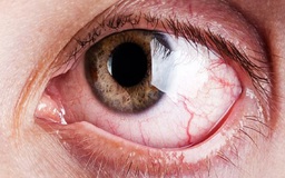 Đến bệnh viện khám, người đàn ông phát hiện hơn 10 con giòi trong mắt