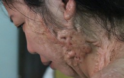 Nỗi đau người phụ nữ vá xe bị tạt axit trên vỉa hè